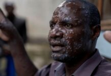 Épidémie de Mpox en Guinée: 04 nouveaux suspects enregistrés, l’unique cas confirmé guéri